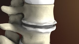 Degenerative Disc Disease Spondylosis explained by Spine Surgeon Dr Jessica Shellock Plano TX [upl. by Engelbert]