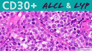 Anaplastic Large Cell Lymphoma amp Lymphomatoid Papulosis CD30 Positive Lymphoproliferative Disorders [upl. by Laing270]