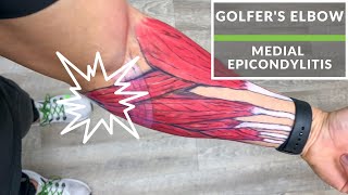 Medial Epicondylitis quotGolfers Elbowquot [upl. by Filiano]