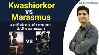 KWASHIORKOR VS MARASMUS difference  Malnutrition disease in child  Full detail in hindi [upl. by Akkina]