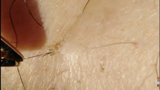 remove GROSS Huge Ingrown hairLARGE Blackheads amp Whiteheads removal [upl. by Cameron979]