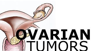 Ovarian Pathology amp Tumors [upl. by Atiram]