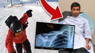 I BROKE MY COLLAR BONE  LIVE FOOTAGE [upl. by Yessej]