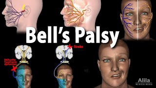 Bells Palsy Pathophysiology Symptoms Diagnosis and Treatment Animation [upl. by Riess]