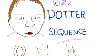 Potter sequence  Oligohydramnios Lowset Ears Flat Face ParrotPeak Nose Lung Hypoplasia [upl. by Brok]