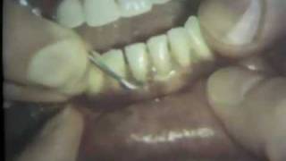 Scaling and Root Planing Part II Mandibular Teeth [upl. by Naeerb]