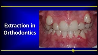 Extraction in Orthodontics [upl. by Clarence]