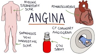 Understanding Angina Visual Explanation for Students [upl. by Hibbitts]