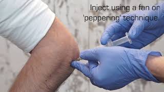 Injection Technique for Lateral Epicondylalgia [upl. by Allare]