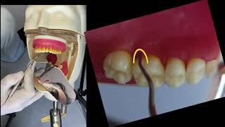 Raspagem periodontal supragengival  Primeiro sextante [upl. by Crispas442]