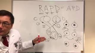 RAPD Relative Afferent Pupillary Defect MarcusGunn pupil [upl. by Troc16]