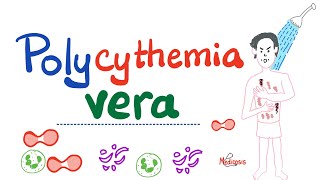 Polycythemia Vera PV  Myeloproliferative Neoplasm MPN  Erythrocytosis  Hematology [upl. by Eilema352]