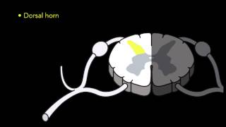 HF10 Spinal Cord Stimulation Part 2 Surgery [upl. by Eixid]