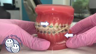 Elastics in Orthodontics  Overview [upl. by Damalis]