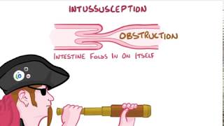 intussusception [upl. by Limaj]