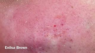 Blackheads Extractions Christian Part 2 [upl. by Tatia]