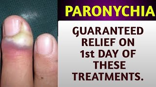 Paronychia Home remedies  Finger nail infection  skin infections  Onychomycosis Treatment [upl. by Nosnarb305]