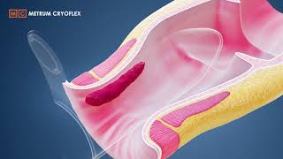 MILH procedure  Minimally Invasive Laser Hemorrhoidoplasty METRUM CRYOFLEX [upl. by Gibbie539]