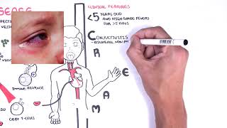 IgA Vasculitis HenochSchonlein Purpura [upl. by Mcnelly924]