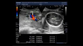 Ultrasound Video showing extreme of Oligohydromnios is Anhydramnios [upl. by Hillel]