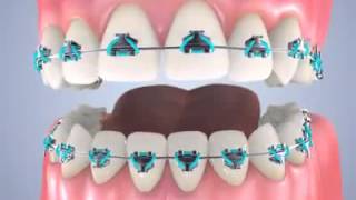 Complete Orthodontic Treatment [upl. by Maller]