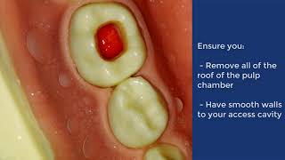 Pulpotomy of Deciduous Molar  QMUL [upl. by Adarbil]