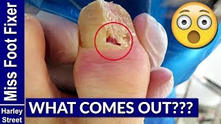 How to Treat Paronychia by Miss Foot Fixer Marion Yau [upl. by Nialb]