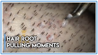 Hair Root Pulling Moments HAIR TRANSPLANT SURGERY [upl. by Nevins493]