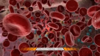 Behind the Mystery Polycythemia Vera [upl. by Rafat574]