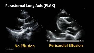 Cardiac Ultrasound Basic Pathology [upl. by Ssilb]