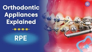 Orthodontic Appliances Explained  RPE [upl. by Clovah]