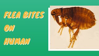 Flea Bites Vs Bed Bug Bites [upl. by Allehs]