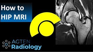 How to Read Hip MRI [upl. by Aikrehs]