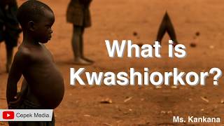 What is Kwashiorkor disease  Medical Science  General Medicine [upl. by Yeltnerb]