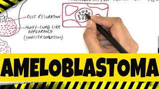 Ameloblastoma  Origination Clinical Radiographic amp Histopathologic features [upl. by Inol543]