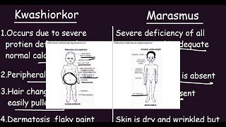 Kwashiorkor vs Marasmus Quick Differences amp Comparison [upl. by Slin]