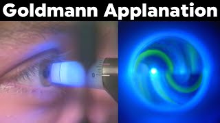 Goldmann Applanation Tonometry Procedure Technique Tutorial [upl. by Nadiya712]