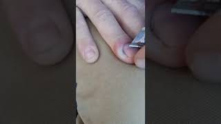 Infected cuticle on finger  Paronychia [upl. by Loredo]