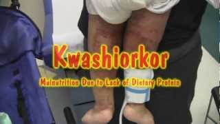 Kwashiorkor [upl. by Atnauqahs]