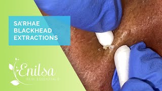 Sa’Rhae Blackhead Extractions [upl. by Danialah]