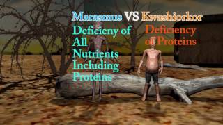 Marasmus Difference Between Marasmus Cachexia and Kwashiorkor [upl. by Biddick]