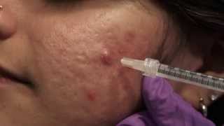 Watch amp Learn Intralesional injections [upl. by Moreno611]