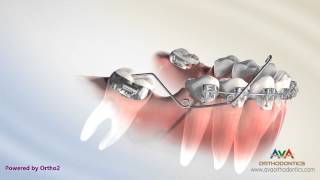 Orthodontic Treatment for Molar Uprighting  Cantilever Spring [upl. by Capone441]