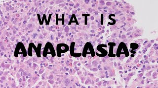 What is Anaplasia  Pathology mini tutorial [upl. by Ennad]