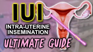 IUI  Fertility expert secrets for maximum pregnancy rates [upl. by Norvin]