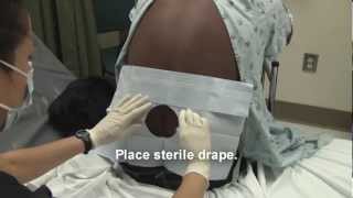 Adult Spinal Tap Procedure Video [upl. by Nido]