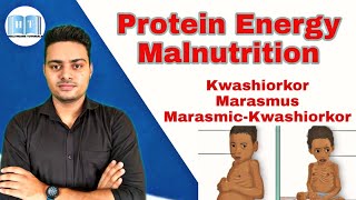 Protein Energy Malnutrition  Kwashiorkor Vs Marasmus [upl. by Aicillyhp]