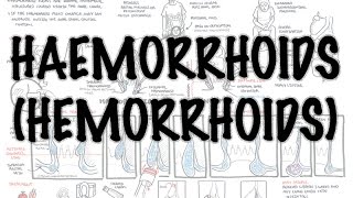 Haemorrhoids Hemorrhoids  Overview pathophysiology investigations and treatment [upl. by Ellezaj]