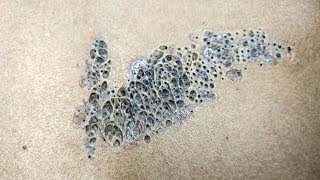 Super Blackheads Largest Blackhead Clusters amp Pimple Pops [upl. by Hoxsie]