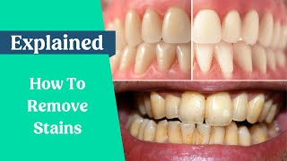 How to remove stains from the teeth [upl. by Astraea]